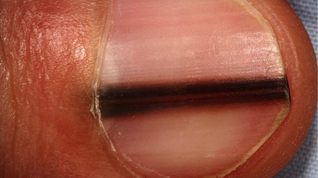 Subungual melanoma on a toe nail