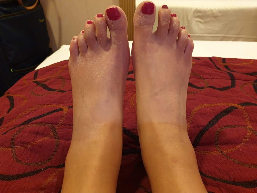A woman's bare feet showing swollen ankles