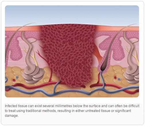 Wart diagram