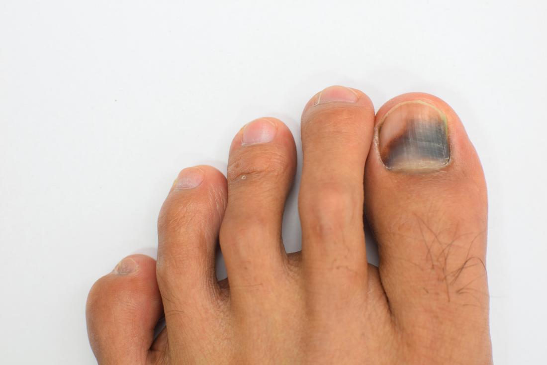 Do I need to worry about my black toenail? - Torbay Footcare