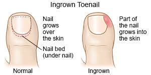 Diagram of an ingrown toenail
