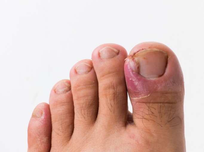 What To Expect During Toenail Fungus Treatment - Great Neck Family Foot Care