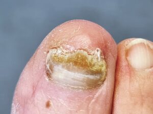 Thickened nails  The Foot Clinic Paignton