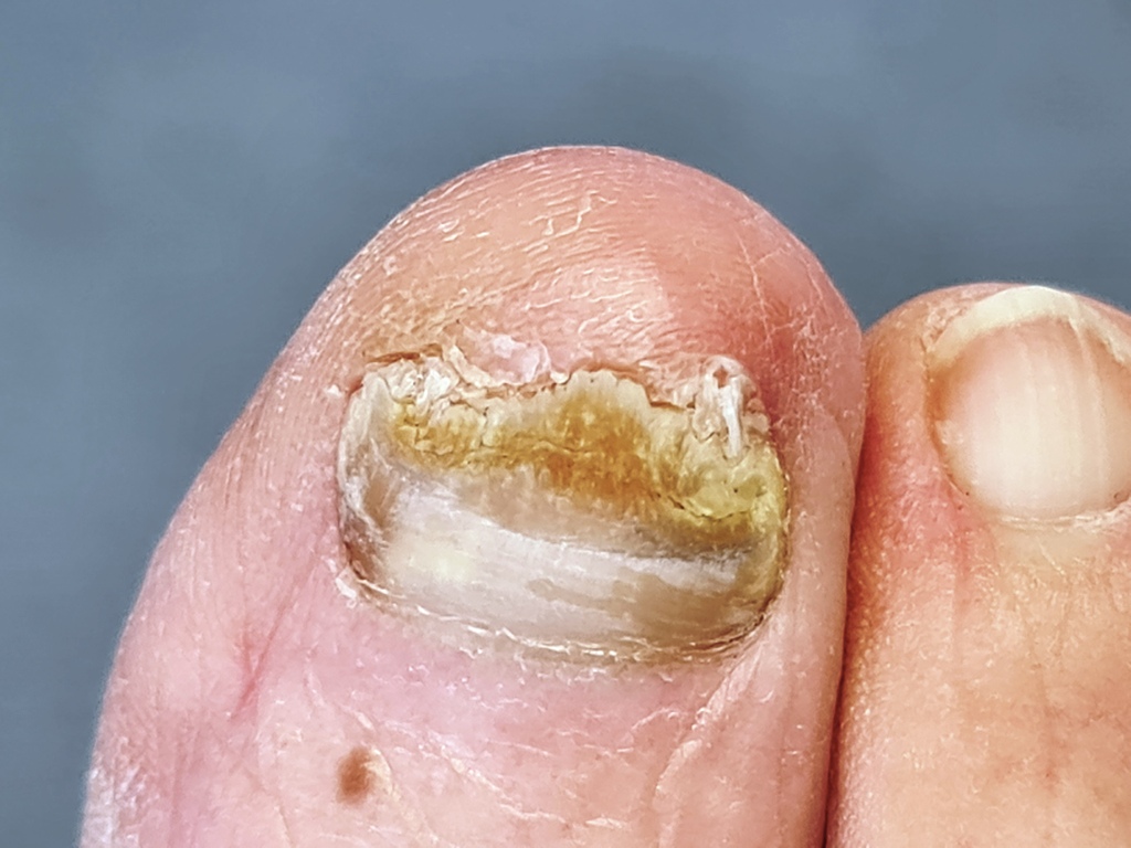 FUNGUS IS NOT FUN - Foot and Ankle Specialists of the Mid-Atlantic