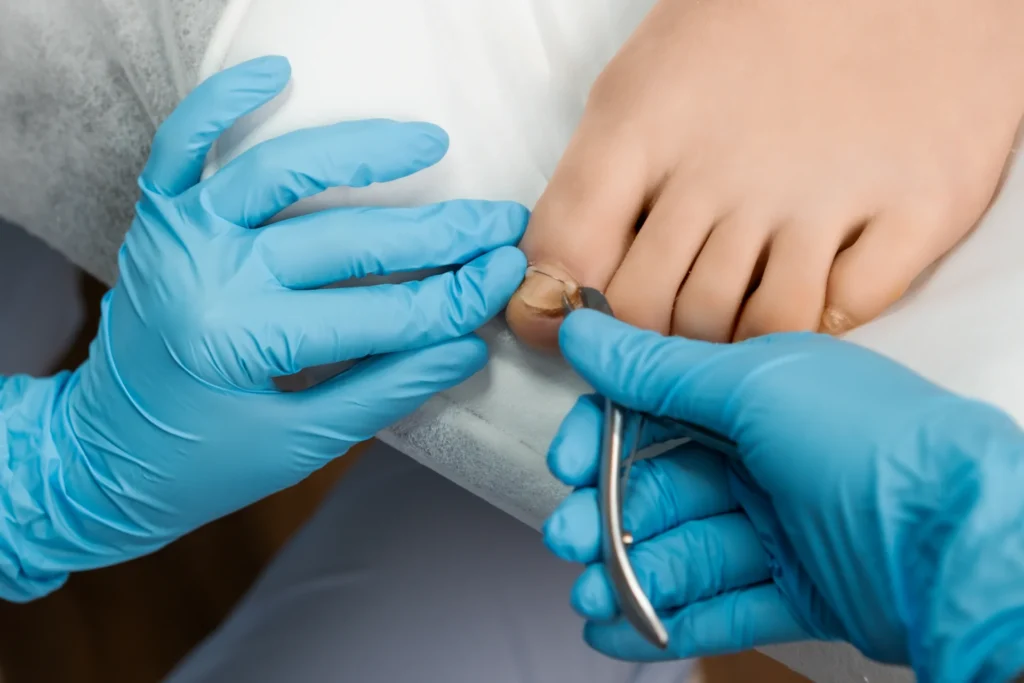 Ingrown Toenails