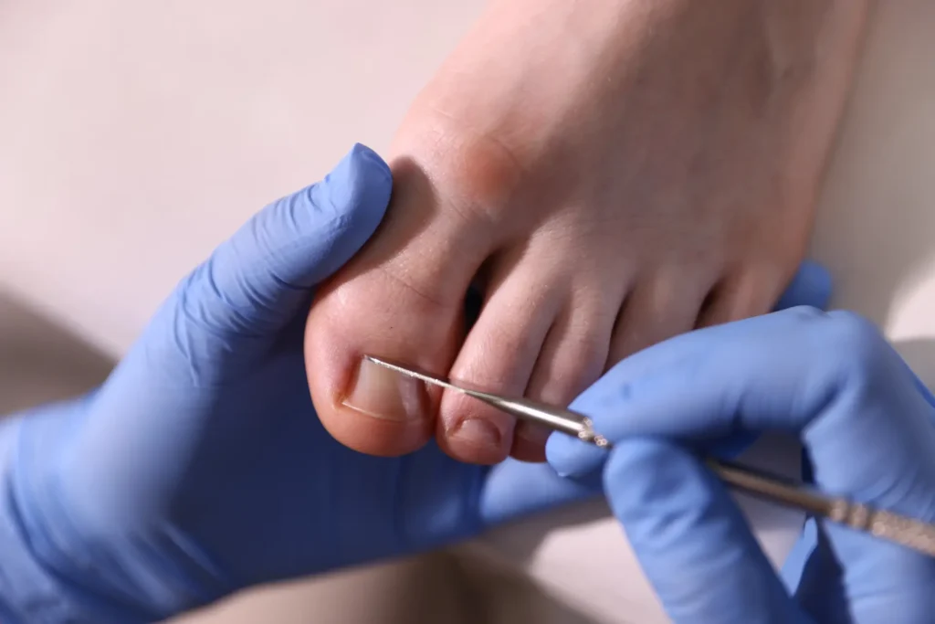 Nail Reconstruction 4