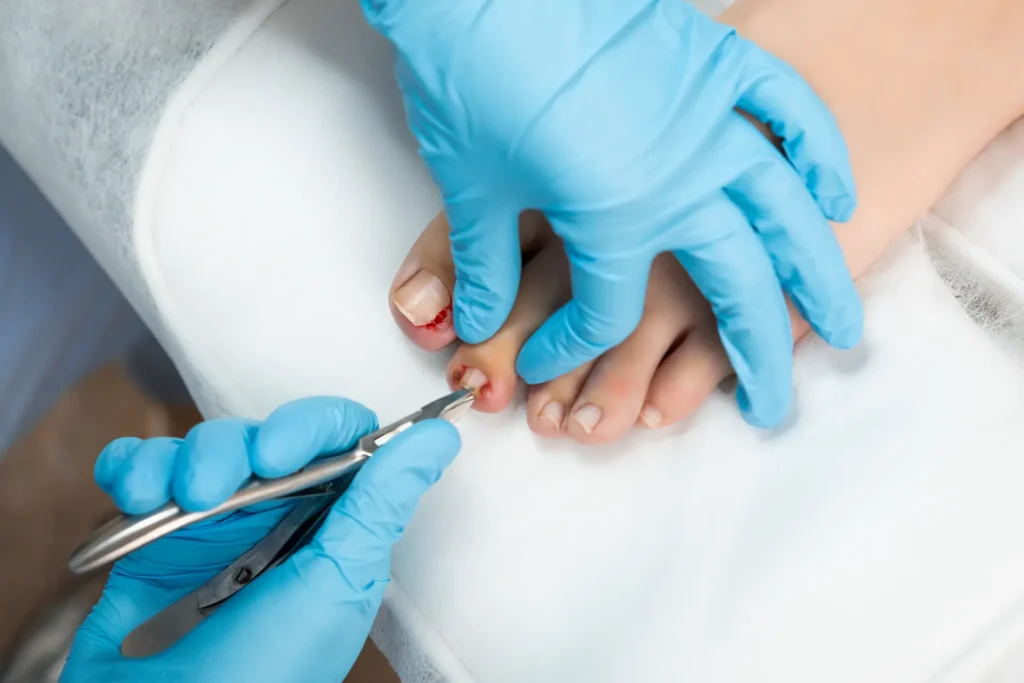 Nail Surgery