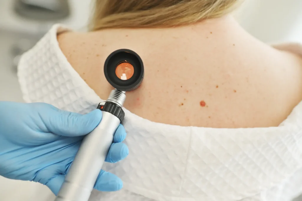 Skin Lesion Removal 1