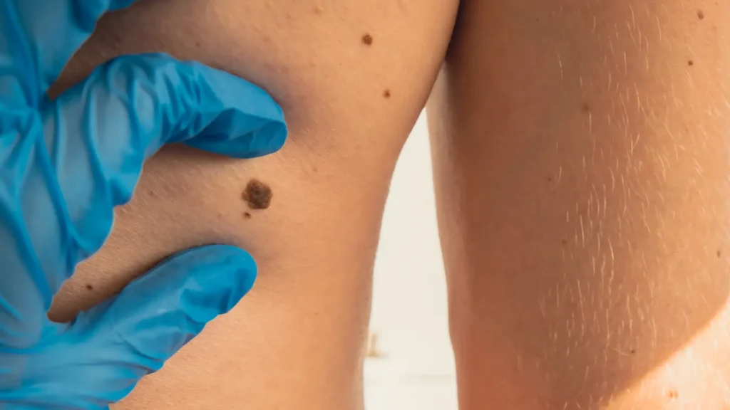 Skin Lesion Removal 3