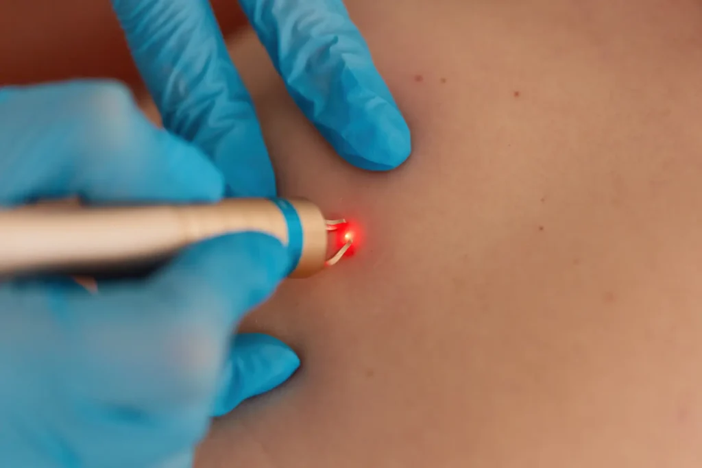 Skin Lesion Removal 4