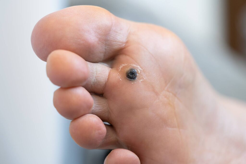 Closeup of wart plantar after cauterizing it with celandine on infected foot. Papillomavirus or HPV