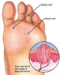 Warts & Verrucas – What are they and how do I get rid of them? 1 torbay footcare Wart 243x300 1