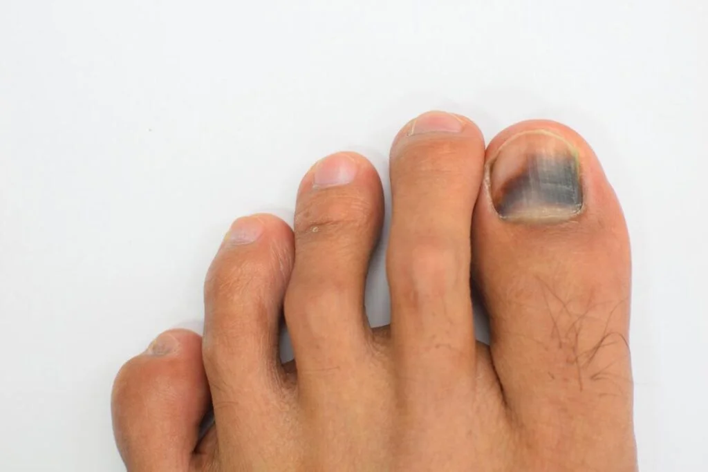 Do I need to worry about my black toenail? 5 torbay footcare hematoma on big toe 1024x683 1