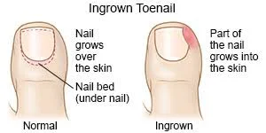 Prevent ingrown toenail pain by following these tips 4 torbay footcare ingrown toenail diagram