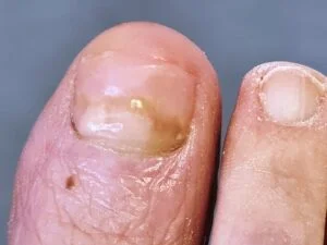 Toenail Restoration and Reconstruction 5 torbay footcare toenail reconstruction 300x225 1