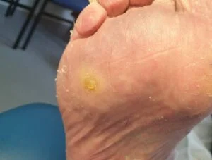 How to Get Rid of Corns & Calluses 9 torbay footcare verruca 300x227 1