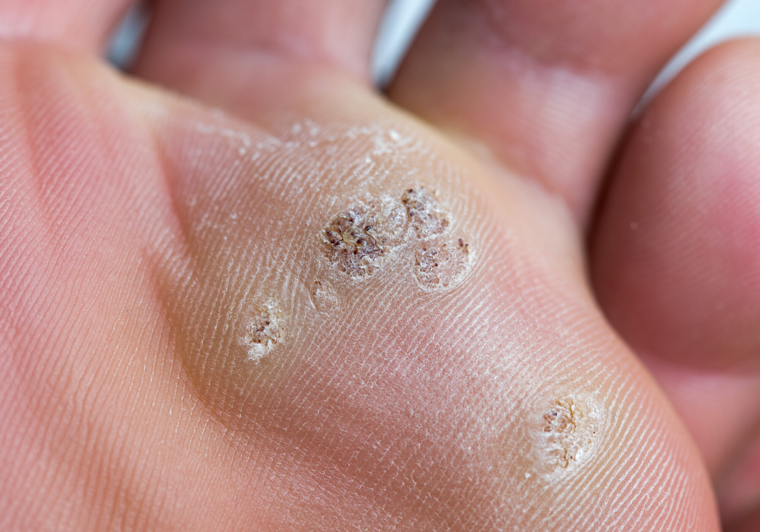 Fungus on the feet of a macro