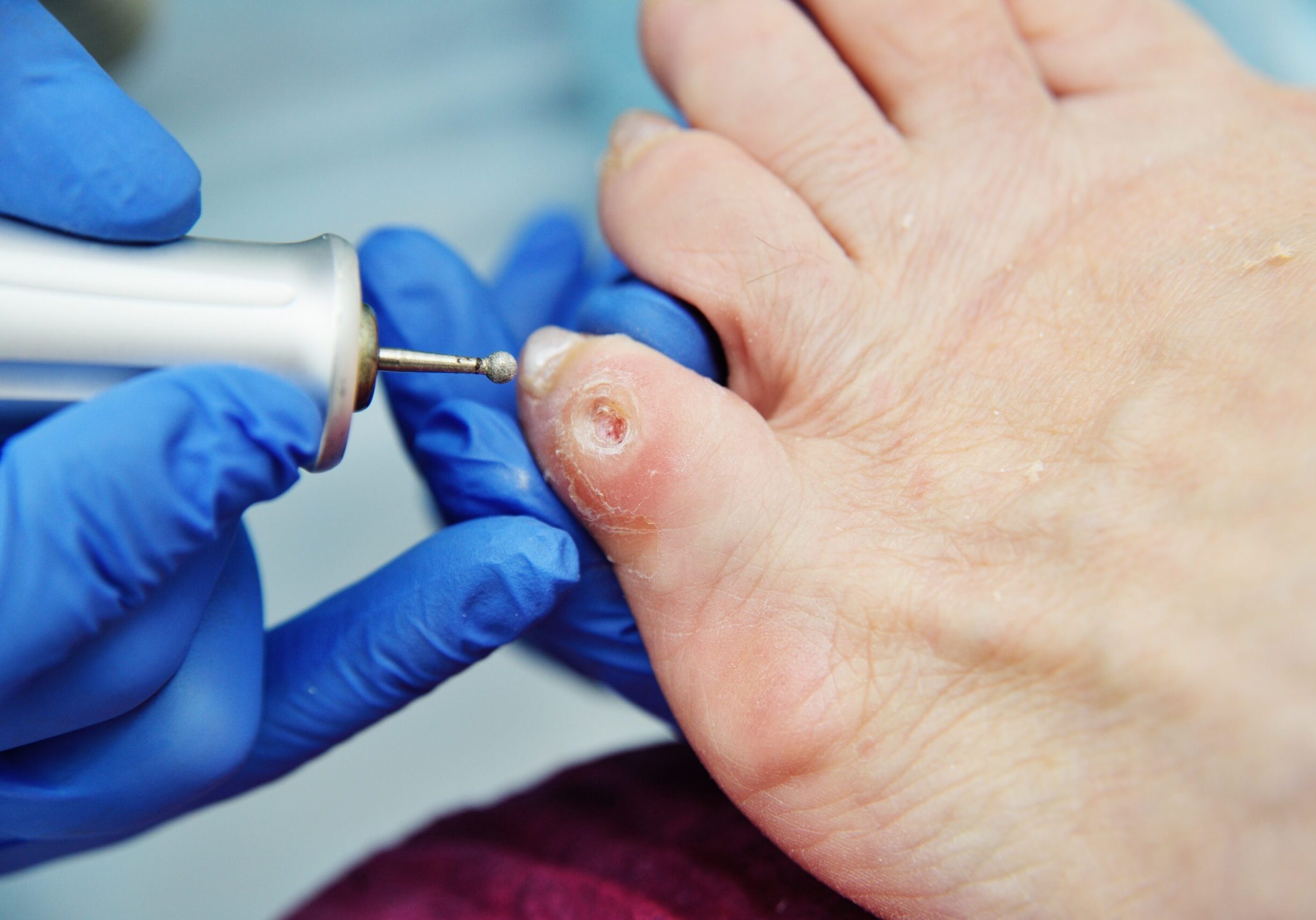 excision of calluses on the toe pedicure machine close-up