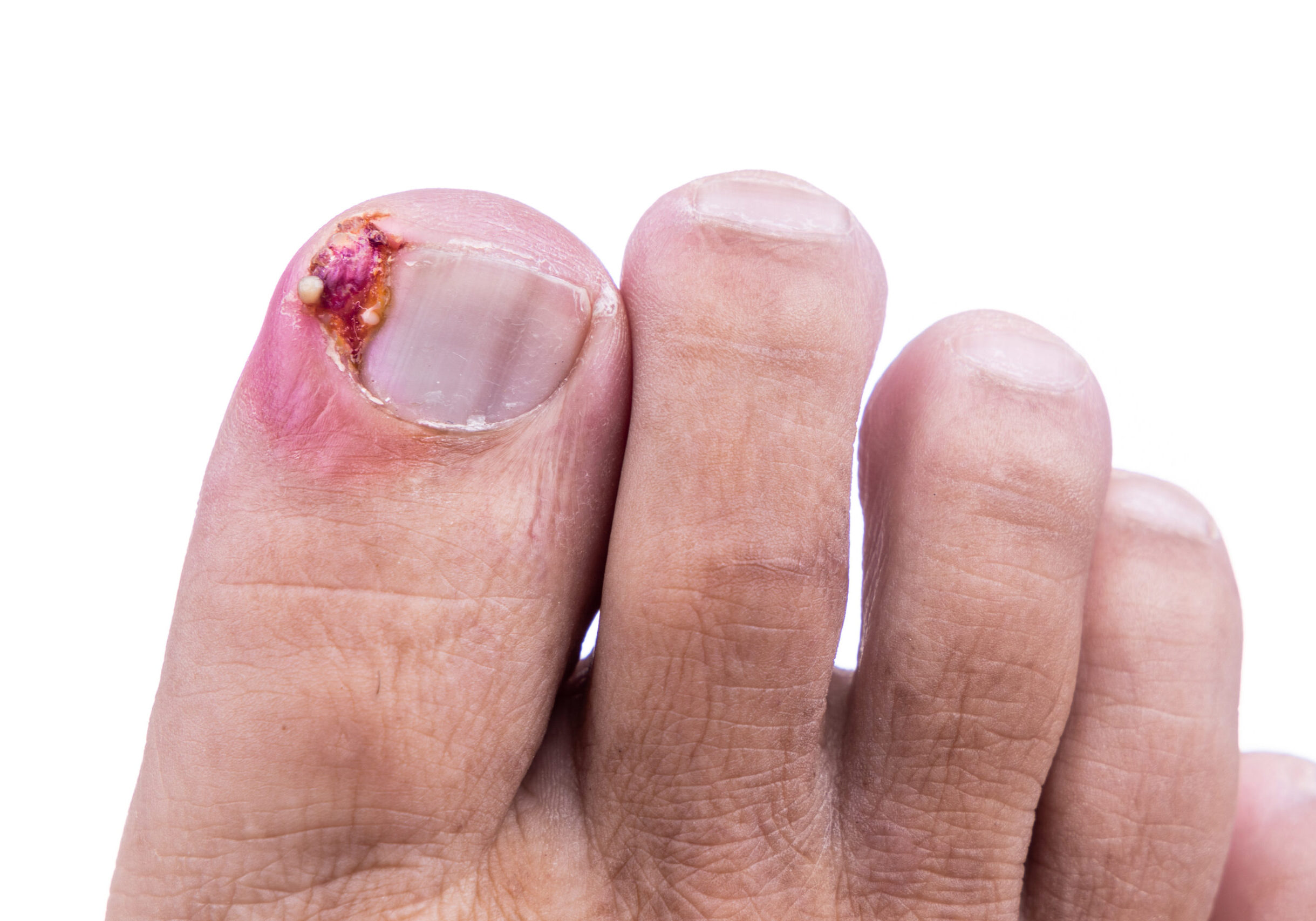 Closeup of inflammation and blood associated with painful ingrown toenail