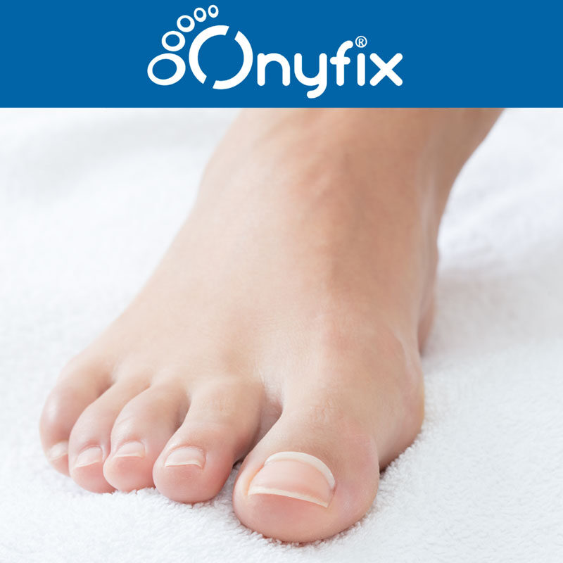 Onyfix-Nail-Correction