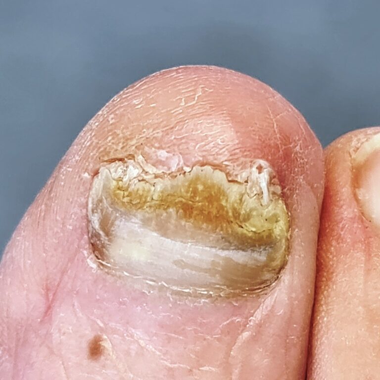 A toe with a fungal nail