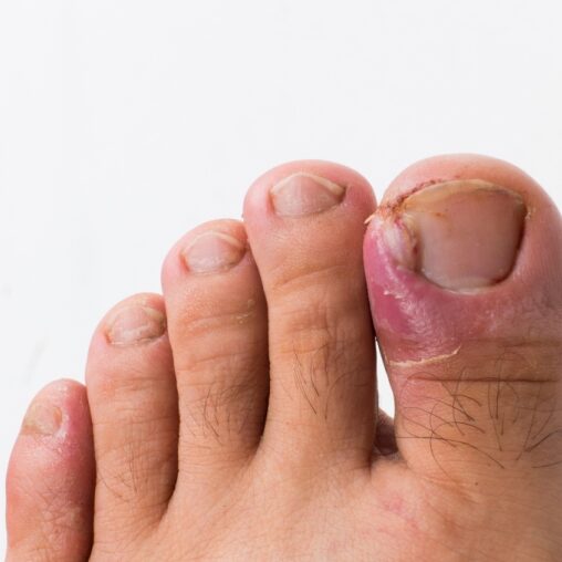 Foot with ingrown toenail